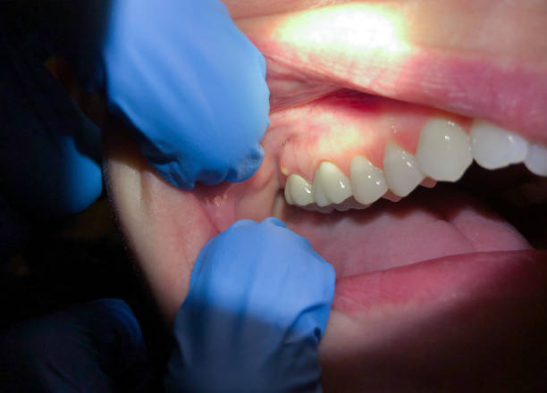 Best Urgent Care for Lost Fillings or Crowns in Tamaqua, PA
